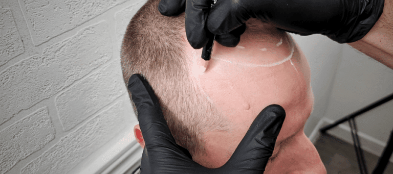 Scalp Micropigmentation for Baldness - Tailored Ink Toronto