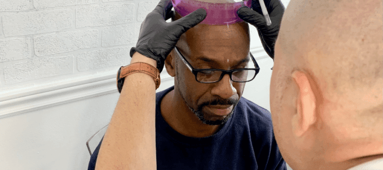 Scalp Micropigmentation Blog - Tailored Ink Toronto 2025