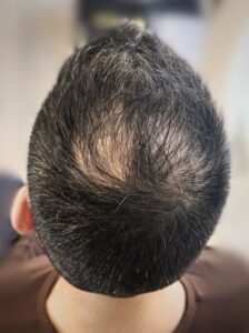 Scalp micropigmentation before and after of a male client with hairline restoration.