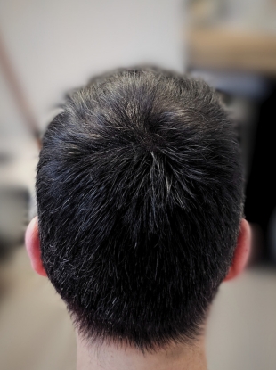 Scalp micropigmentation before and after of a male client with hairline restoration.