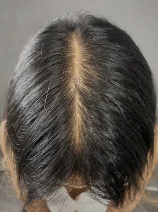 Female client showcasing density improvement with scalp micropigmentation.